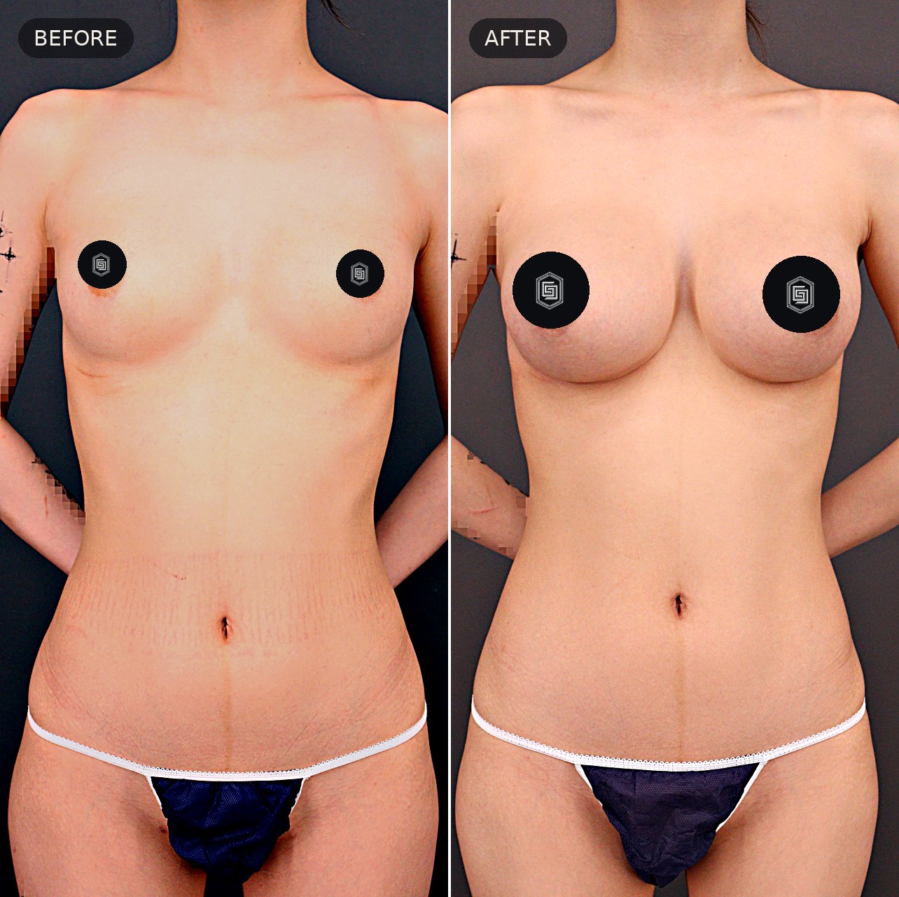 Breast augmentation — before and after