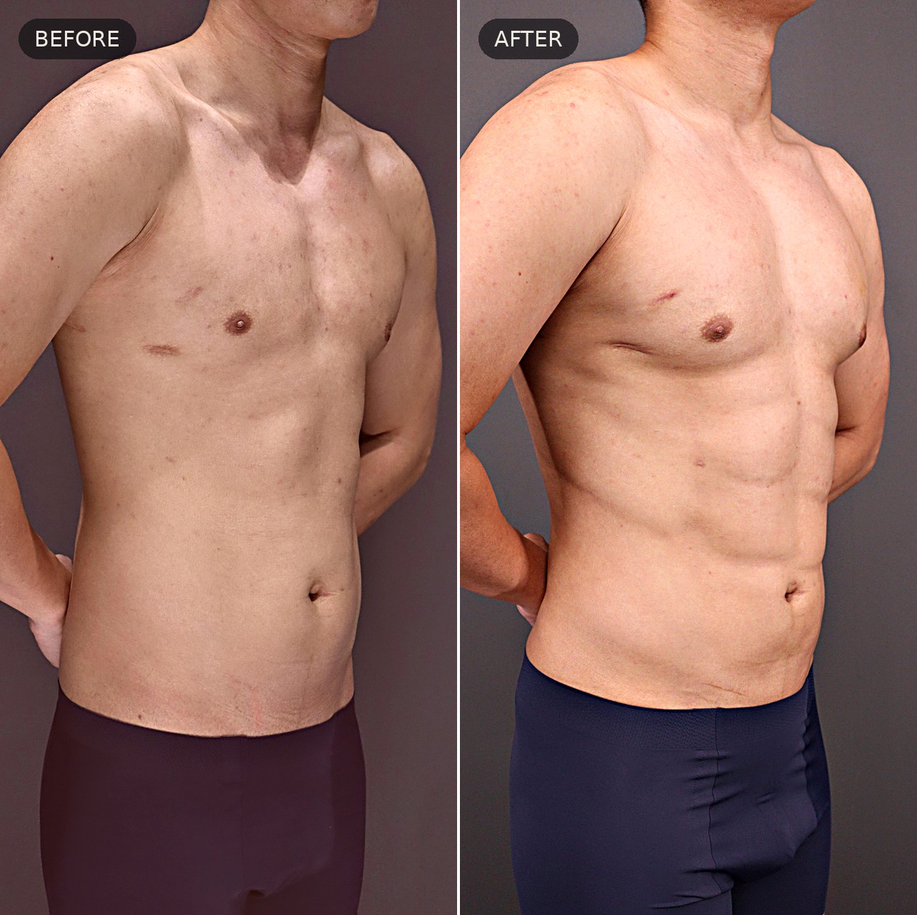 Male body contouring — before and after