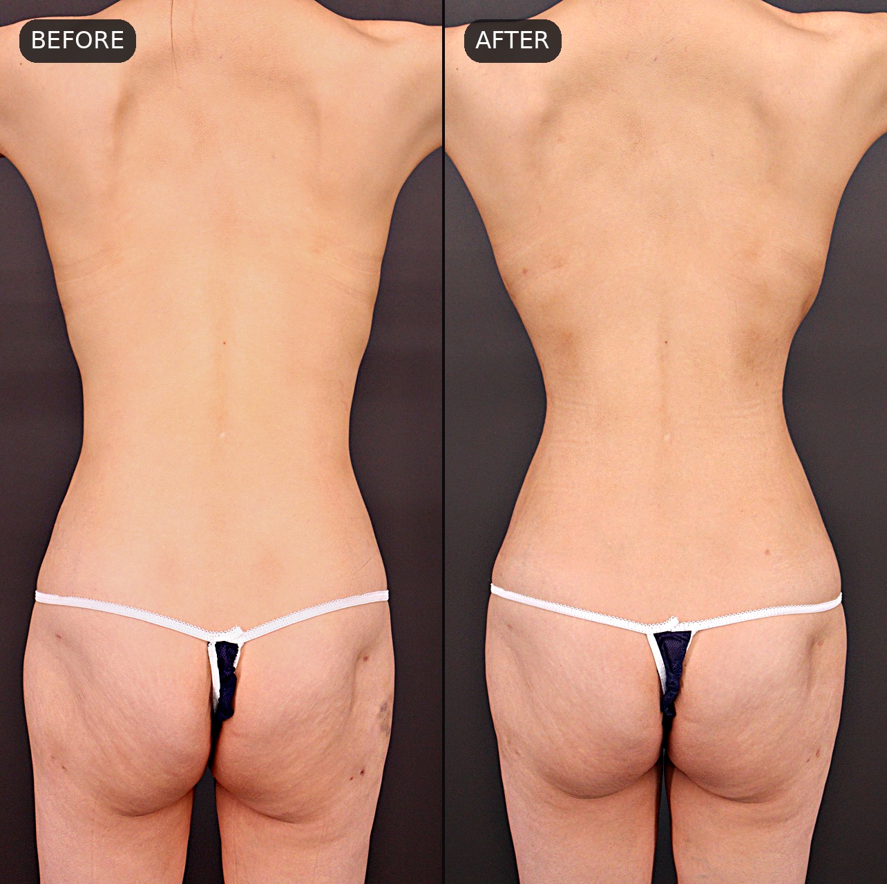 Rib remodeling — before and after